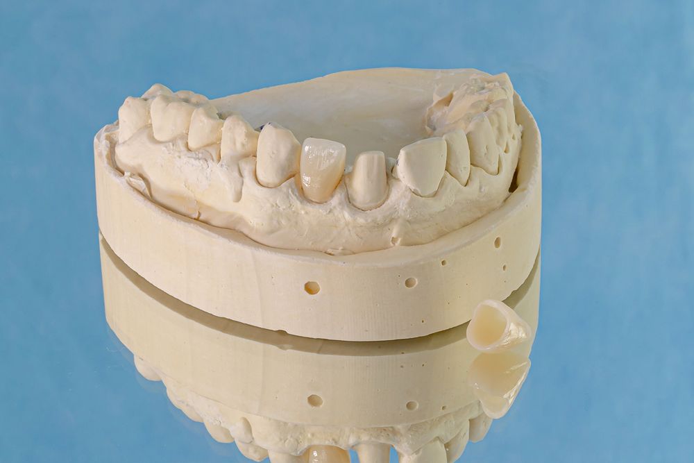 dental crowns 3Dental